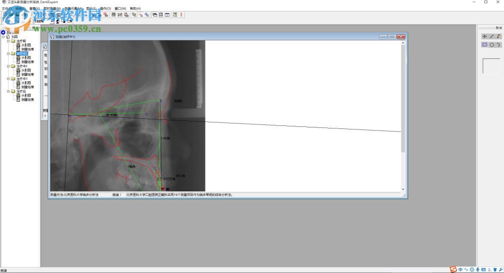 艾坚头影测量分析系统下载(DentiExpert) 2.2 官方版